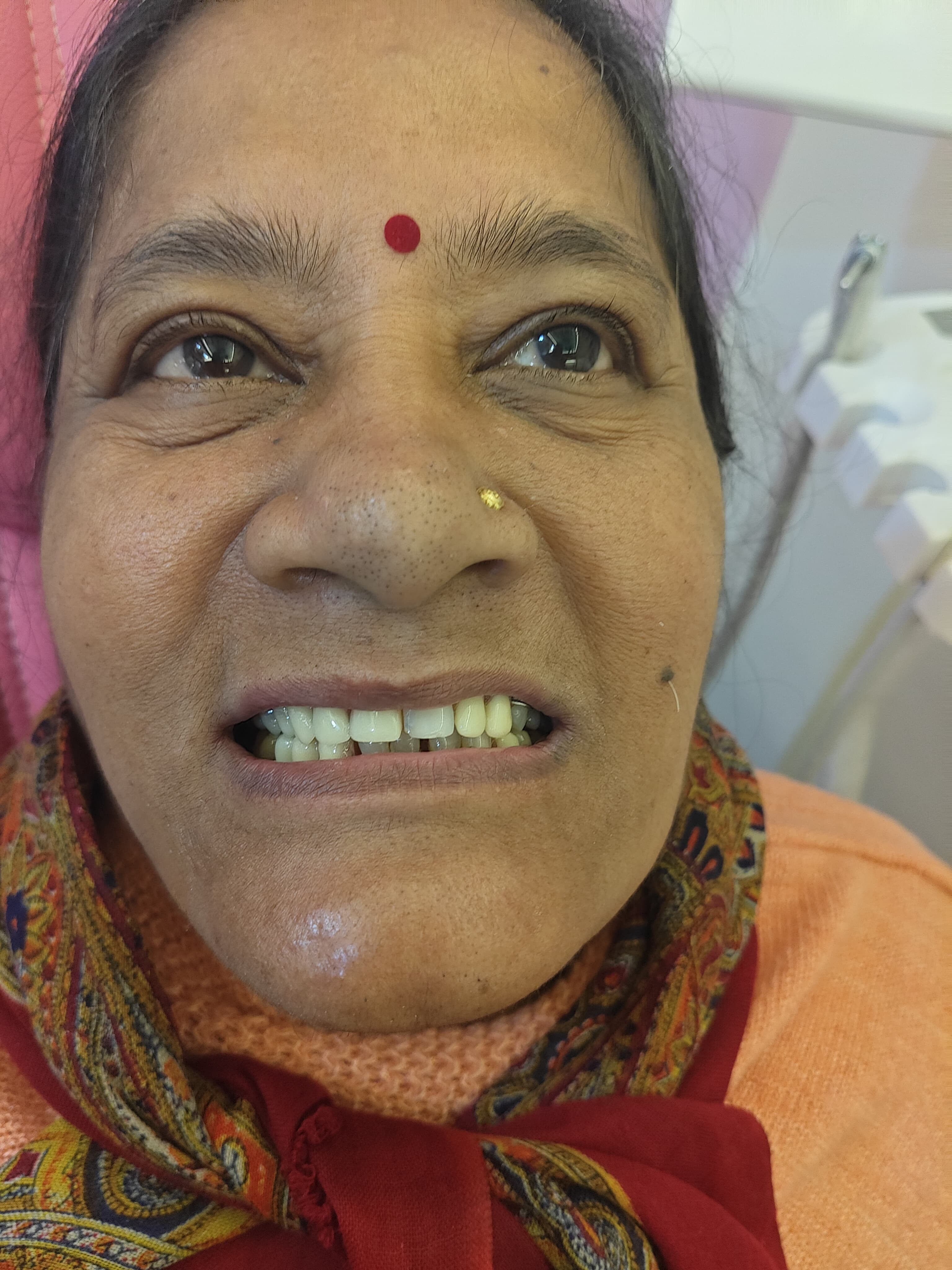 Smile Transformation Case 10